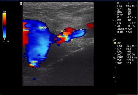 Dialysis Fistula Ultrasound