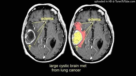 Les métastases cérébrales sont des complications fréquentes du cancer