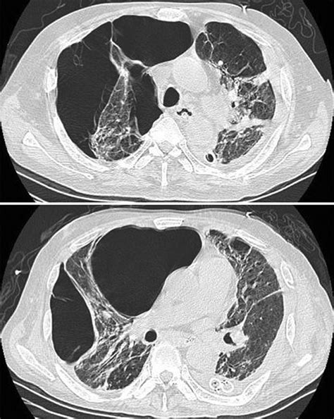 Non Surgical Management Of Giant Lung Bullae During Mechanical