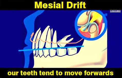 MESIAL DRIFT: Our teeth tend to move forwards