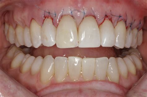 allograft issaquah wa northwest periodontics implants