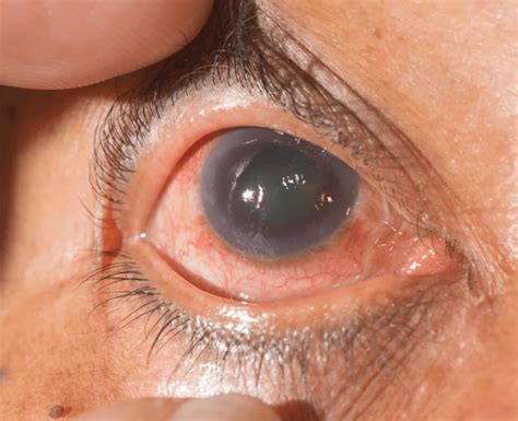 Bệnh cườm nước Glaucoma là gì Một số lưu ý và điều trị