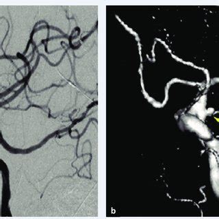 Ac Show The Mra Cta And D Dsa Respectively Of The Left Internal