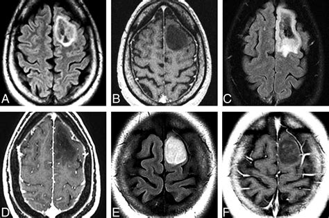 The 2021 World Health Organization Classification Of Tumors Of The