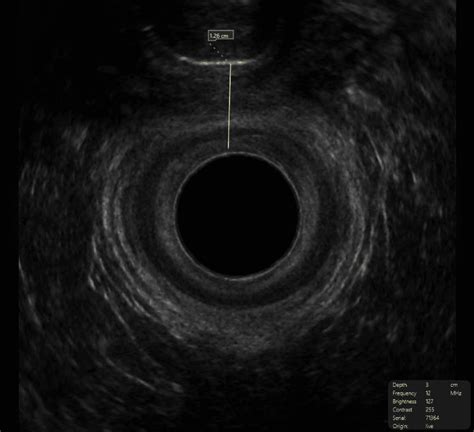 Endo Anal Ultrasound Expert Imaging Of The Anal Muscles Dr Katalin
