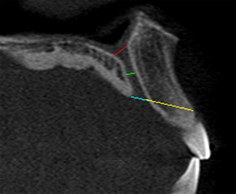 Measurement Of Incisive Foramen Blue Line Nasal Foramen Red Line