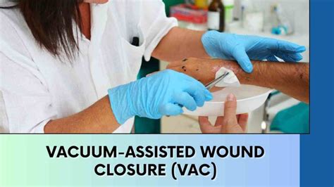 Understand The Vacuum Assisted Wound Closure Vac