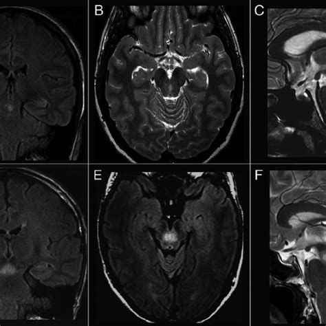 Mri Showing The Isolated Paramedian Midbrain Lesions Of The Two