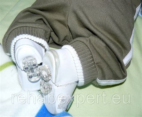 Bebax Shoes Брейсы Бебакс для Лечения Косолапости и Реабилитации детей ...