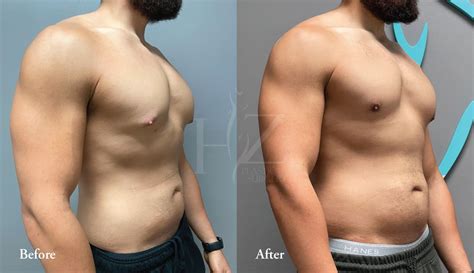 Gynecomastia Before And After Bodybuilder