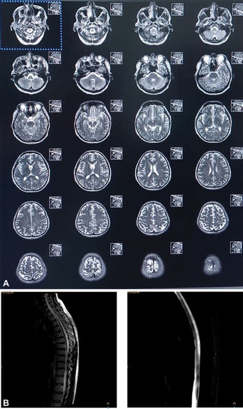 Brain And Spine Mri Of The Patient The T2wi Axial Brain Mri T2wi