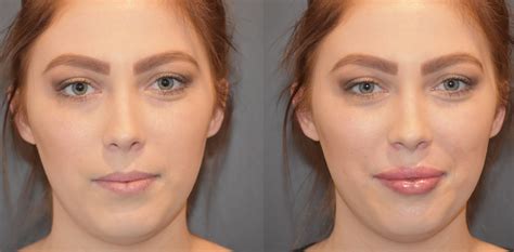 Before After Lip Fillers Cape Town Dr Gideon Maresky