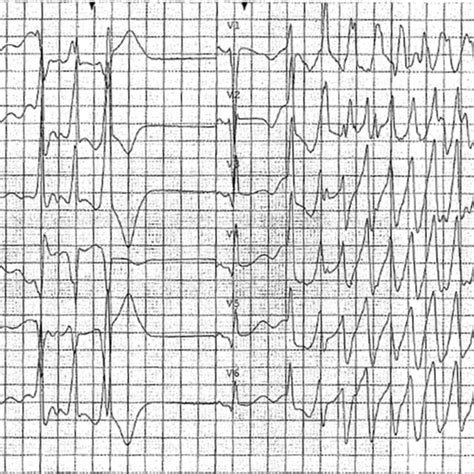 Triggered Polymorphic Ventricular Tachycardia Polymorphic Ventricular