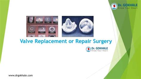 PPT - Valve Replacement Surgery PowerPoint Presentation, free download ...