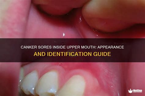 canker sores  upper mouth appearance  identification guide