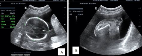 A. USG showing normal twin; 1B. USG showing Acardiac twin | Download