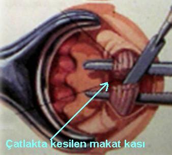 Anal Fissür Makat Çatlağı Tedavi