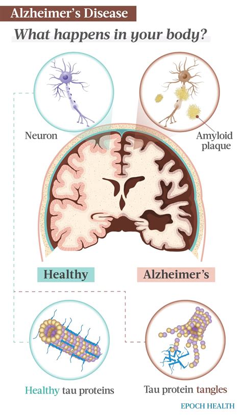 The Essential Guide to Alzheimer’s Disease: Symptoms, Causes