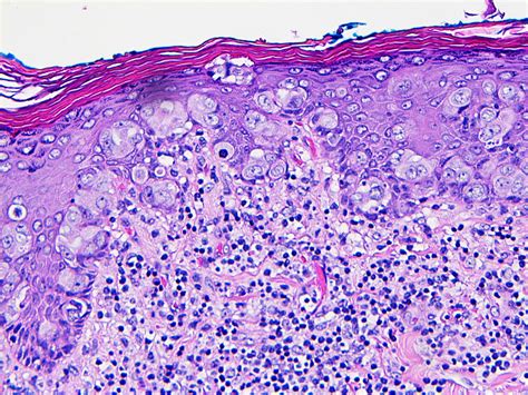 Paget S Disease Head
