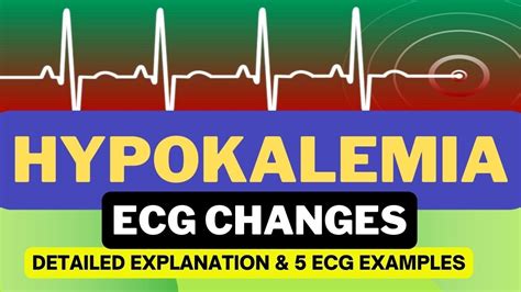 ECG Changes In Hypokalemia Hypokalemia ECG Changes Detailed