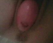 Granny With Uterine Prolapse Amateur Amateur Porn Xhamster