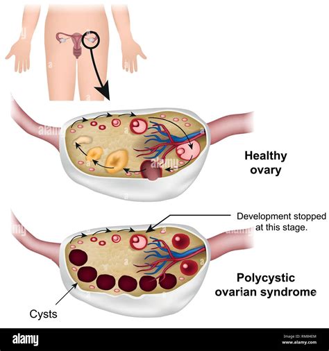 Polycystic ovary syndrome hi-res stock photography and images - Alamy