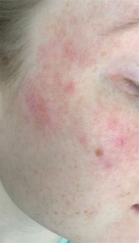 Rosacea Anyone 2nd Trimester Experiences Forums What To Expect