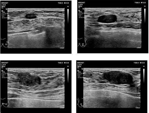 frontiers case report fibroadenomas   atypical ductal