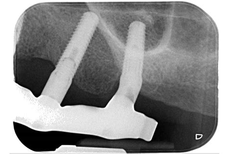 Full Maxillary Reconstruction With Maxgraft® Bonebuilder Dr C