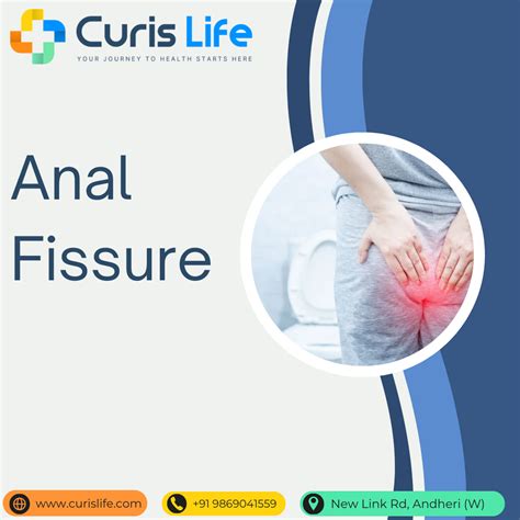 Anal Fissure Treatment In Andheri West Curis Life Clinic