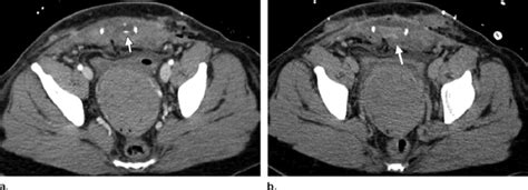 Rectus Sheath Hematoma Treatment