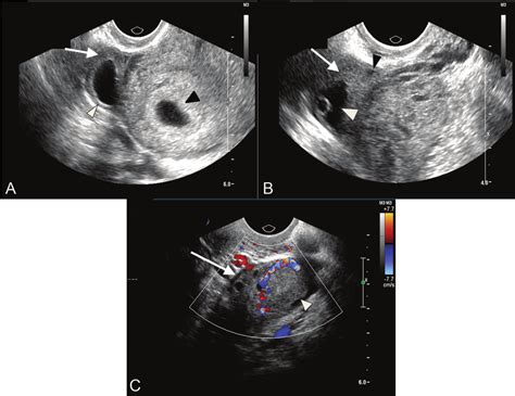 Transvaginal Ultrasonographic Visualization Of A Right Ovarian Download Scientific Diagram