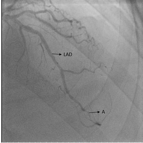 Coronary angiogram showing LAD (left anterior descending artery) and ...