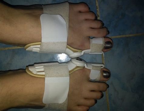 Hallufix - ортопедическая шина: применение, противопоказания