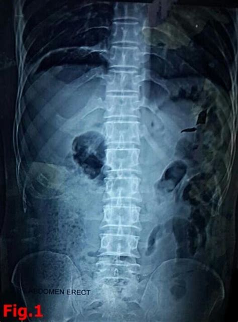 X Ray Abdomen Erect Showing Gas Under The Diaphragm Download Scientific Diagram