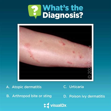 Off Trail Hike Leads To Severely Pruritic Rash Lets Diagnose Visualdx