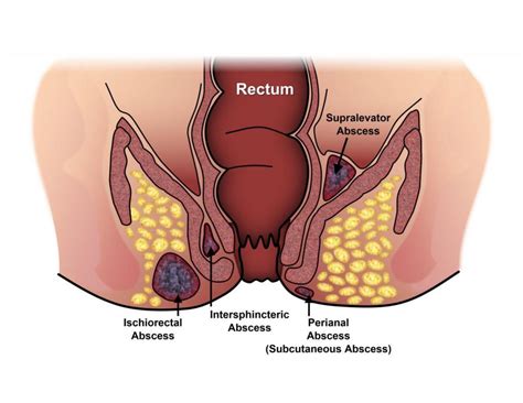 Anal Abscesses And Fistulas Treatment Surgi TEN Specialists
