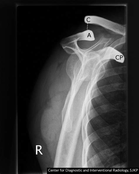 Acromioclavicular Separation X Ray