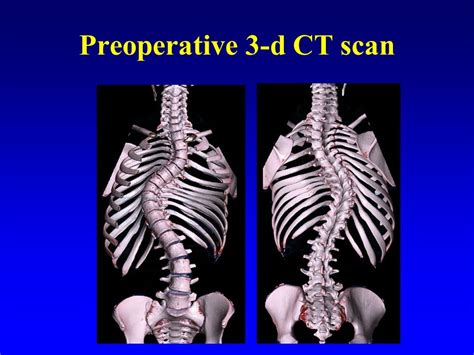 Severe Idiopathic Scoliosis Treated With Preoperative Halo Gravity