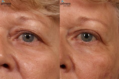Laser Skin Resurfacing Dot Co2 Before And After Pictures Case 16