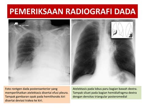 Slide Atelektasis Paru