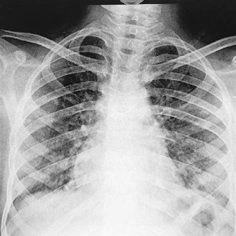 Chest Posteroanterior Radiograph Showing Small Parenchymal Nodules In