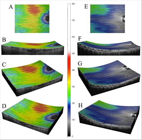 Choroidal Volume Variations With Age Axial Length And Sex In Healthy Subjects A Three