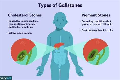 How to treat gallbladder stones? - Healthy Food Near Me