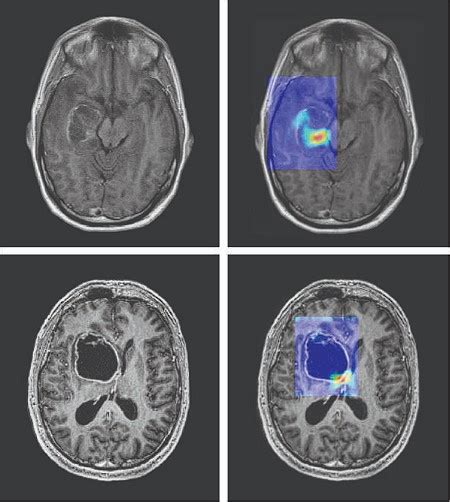 Early Detection of Cancer- AI Model Identifies Cancer Cells Early - New ...
