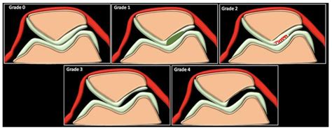 Life Free Full Text Imaging Of Cartilage And Chondral Defects An