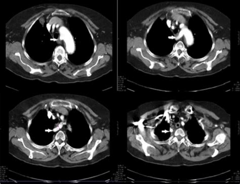 white arrows show  subclavian aberrant artery type  patient