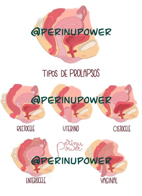 Prolapso Algo Asoma Por Mi Vagina Luce Tu Embarazo