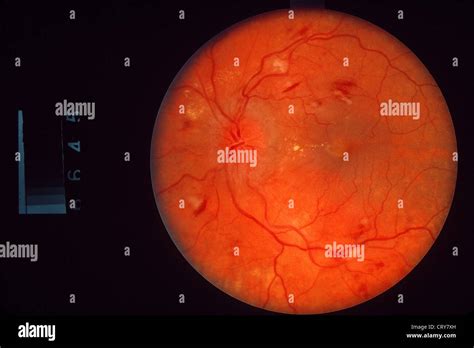 Hypertensive Retinopathie Fotos Und Bildmaterial In Hoher Aufl Sung