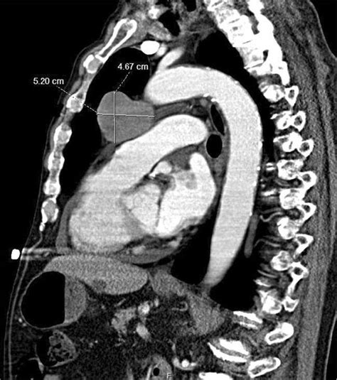 Sagittal Section Thorax